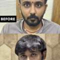 Hair Transplant For Man In Ahmedabad
