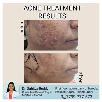 Kurnool, Health, Best Acne & Scars Treatment At Dermacure - Rajahmundry