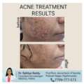 Best Acne & Scars Treatment At Dermacure - Rajahmundry