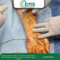 Restore Nerve Function With Expert Peripheral Nerve Surgery In Ahmedabad