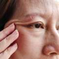 Eyelid Surgery In Los Angeles