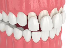 New York, Dental, Dental Porcelain Veneer In China: Healthy And Radiant Smile