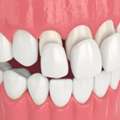 Dental Porcelain Veneer In China: Healthy And Radiant Smile