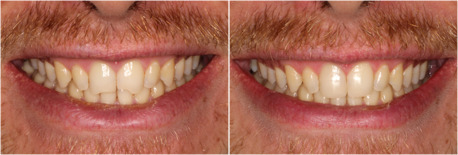 New York, Dental, Dublin Metro Dental Cosmetic Dentistry Columbus Ohio For A Beautiful Smile