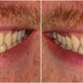 Dublin Metro Dental Cosmetic Dentistry Columbus Ohio For A Beautiful Smile
