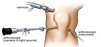 Ahmedabad, Health, Knee Arthroscopy Treatment In Ahmedabad &ndash; Advanced Minimally Invasive Solution For Knee Pa