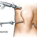 Knee Arthroscopy Treatment In Ahmedabad &ndash; Advanced Minimally Invasive Solution For Knee Pa