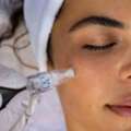 Microneedling Treatment Near Me For Healthier Skin