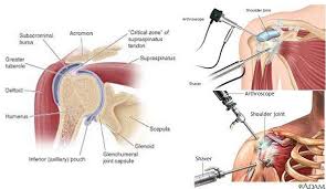 Mumbai, Health, Is Shoulder Pain Limiting Your Daily Activities? Explore Shoulder Arthroscopy Treatment In