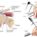 Is Shoulder Pain Limiting Your Daily Activities? Explore Shoulder Arthroscopy Treatment In