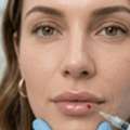 GBP 0300,  How Long Does Lip Filler Last? Timeline & Fade Stages Explained