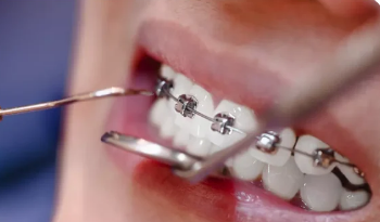 New York, Dental, Professional Dental Cleaning Near You &ndash; Call Now