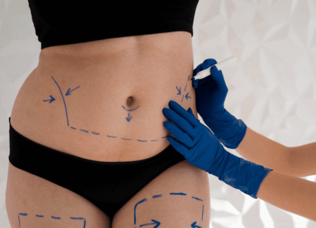 Dubai, Beautician, Non-surgical Liposuction In Dubai - Dr. Mohan Plastic Surgeon