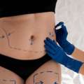 Non-surgical Liposuction In Dubai - Dr. Mohan Plastic Surgeon