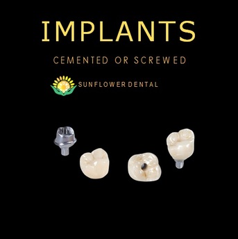 Beijing, Dental, Crown And Bridge Works From China &ndash; Premium Restorations At Competitive Prices