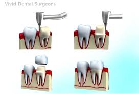 Singapore, Dental, From Braces To Grace: Clear Retainers