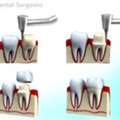 From Braces To Grace: Clear Retainers
