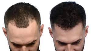 Gurgaon, Health, Hair Transplant In India | Advanced & Affordable Treatment With Mycure Pathway