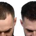 Hair Transplant In India | Advanced & Affordable Treatment With Mycure Pathway