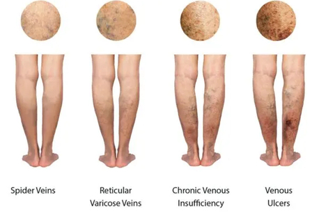 New York, Health, Surprise Elite Vein Clinic