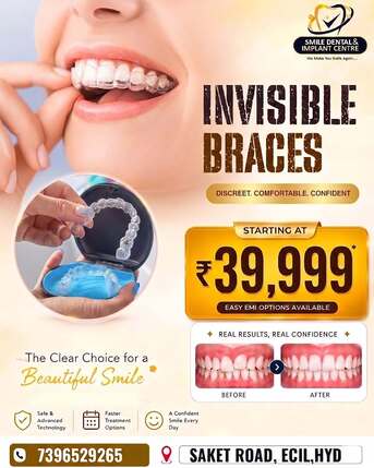 Hyderabad, Dental, Invisalign Near AS Rao Nagar, Hyderabad | Clear Aligners Price
