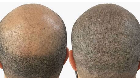 London, Beautician, Professional Hair Pigmentation And Micro Scalp Pigmentation Solutions - Skulltec