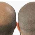 Professional Hair Pigmentation And Micro Scalp Pigmentation Solutions - Skulltec