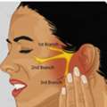 Get Trigeminal Neuralgia Homeopathic Treatment In Zirakpur