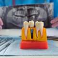 Dental Implant Consultation Wilmington NC
