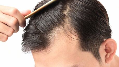 London, Beautician, Effective Hair Loss Solutions For Men In Glasgow &ndash; Skulltec