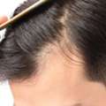 Effective Hair Loss Solutions For Men In Glasgow &ndash; Skulltec