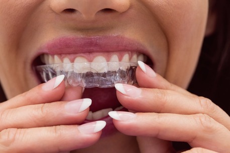 New York, Dental, Invisalign Treatment Wilmington NC | Clear Aligners For A Straighter Smile