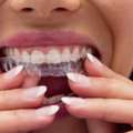 Invisalign Treatment Wilmington NC | Clear Aligners For A Straighter Smile