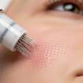 Trusted Microneedling Murfreesboro Skin Rejuvenation Services