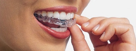 Thane, Dental, Clear Aligners And Invisalign Treatment In Thane