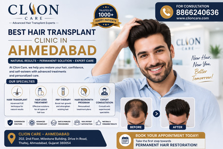 Ahmedabad, Health, Hair Transplant Ahmedabad At Beat Price
