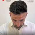 Hair Transplant Surgery Turkey &ndash; UniquEra Clinic Full Package