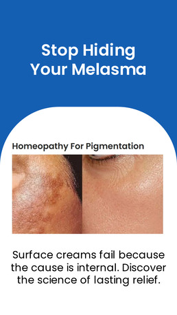 Mumbai, Health, Best Homeopathy Doctor For Melasma In India | Dr. Abhishek Kasana