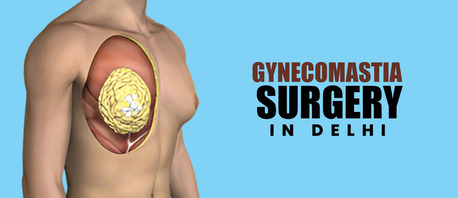 New Delhi, Medical, Best Gynecomastia Surgery In Delhi At LangerSculpt