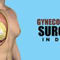 Best Gynecomastia Surgery In Delhi At LangerSculpt
