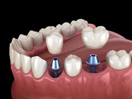 San Diego, Health, Dental Veneers