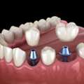Dental Veneers