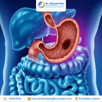 Ahmedabad, Health, Expert Surgical Care For Gastrointestinal Cancer In Ahmedabad