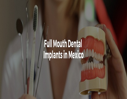 Mexico City, Dental, Full Mouth Dental Implants In Mexico With Teeth Savers