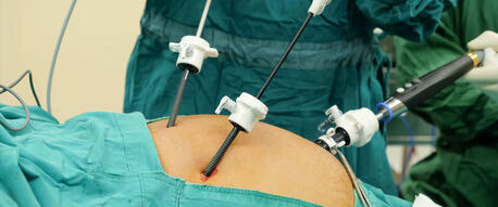 New Delhi, Health, Advanced Laparoscopic Gallbladder Surgery In Delhi With Dr. Ashish Vashistha
