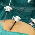 Advanced Laparoscopic Gallbladder Surgery In Delhi With Dr. Ashish Vashistha