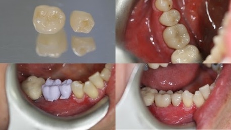 London, Dental, Same Day CEREC Crowns In Marlow For Fast Tooth Restoration