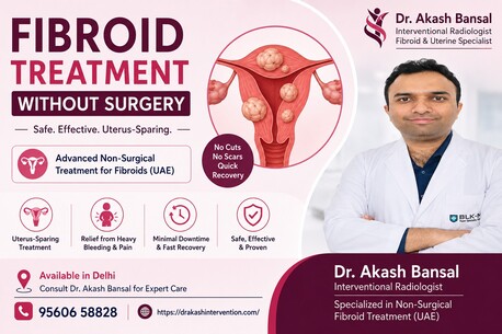 New Delhi, Health, Fibroid Treatment Without Surgery In Delhi | Dr. Akash Bansal