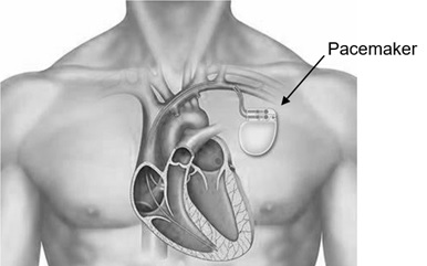 Dubai, Health, Advanced Heart Pacemaker Surgery In UAE