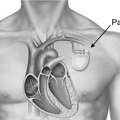Advanced Heart Pacemaker Surgery In UAE